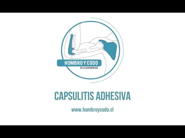 Hombro: Capsulitis adhesiva (hombro congelado)