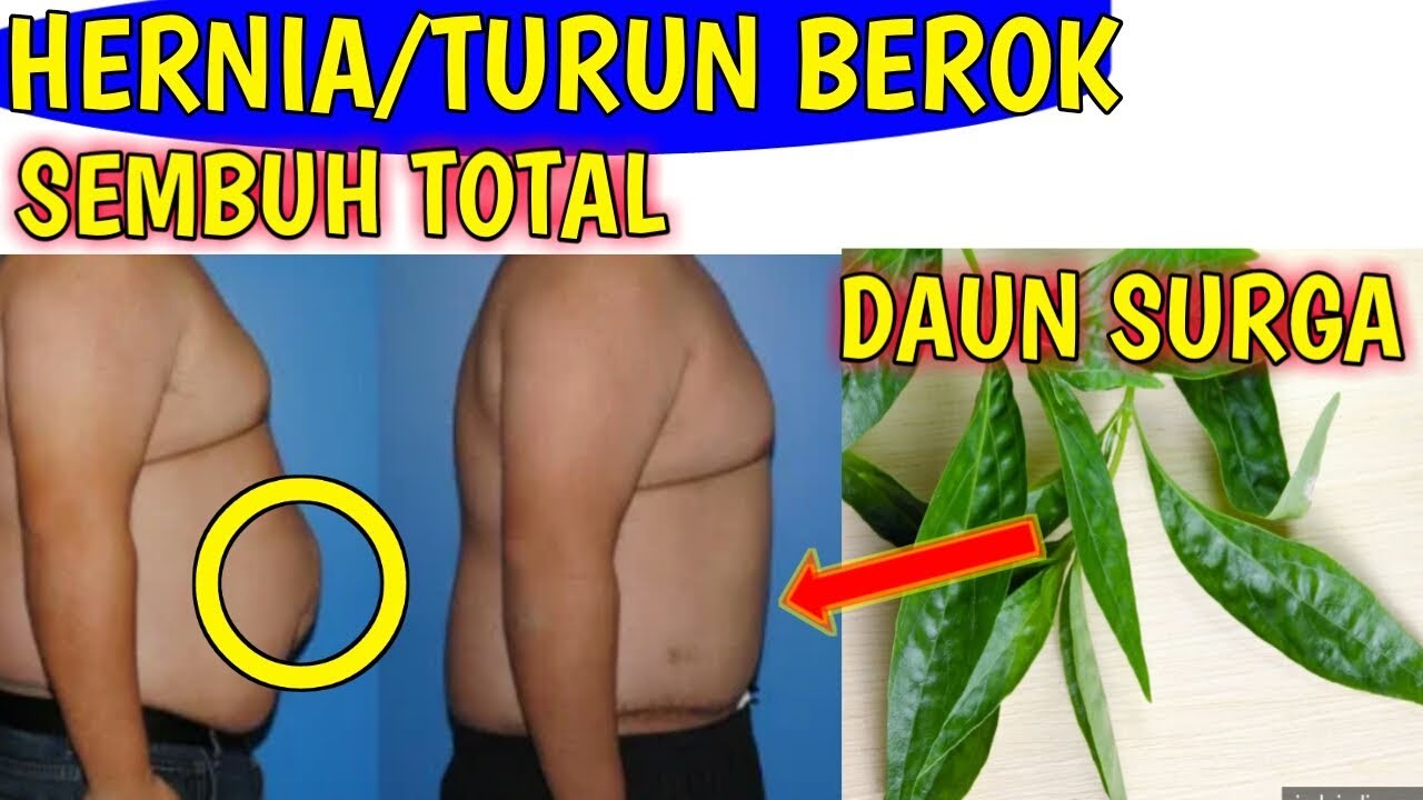 ASLI!!Obat herniaII Obat hernia alami paling ampuhIICara mengobati