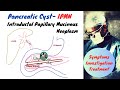 Pancreatic Cyst IPMN
