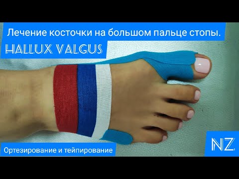 Лечение косточки на большом пальце стопы. Ортезирование и тейпирование. Hallux valgus