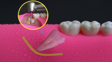 Mesioangular Impacted Wisdom Tooth Removal | All Steps In 4K.