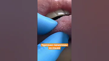 Удаление папилломы