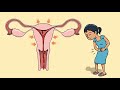 What Are Period Cramps And How To Deal With Them 