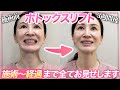 3週間で激変？ボトックスリフト受けてみて医師がレビュー！【痛み・効果】