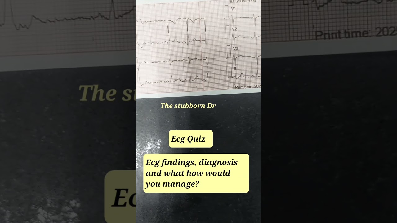 ECG quiz 17! A young pateint with sinking of heart!