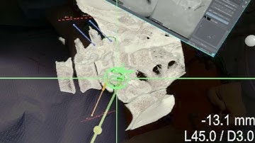 SyncAR Spine - Augmented Reality Spine Surgery