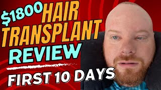 CHEEP HAIR TRANSPLANT RESULTS BEFORE AND AFTER $1800