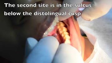 First time Anesthesia with The Wand