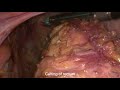 Total proctocolectomy with ipaa and d3 lymph node dissection with ibdassociated colon cancer