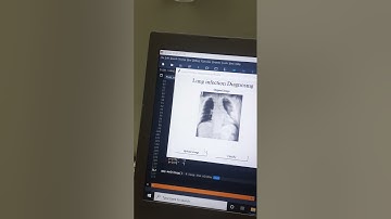 Classification of Infections in Lung X-Ray Images using the Resnet50 Model.