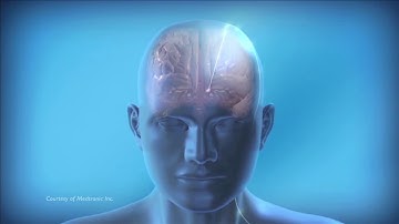 Deep Brain Stimulation (DBS): Overview of Deep Brain Stimulation