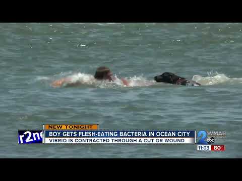 Boy gets flesh-eating bacteria in Ocean City
