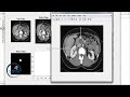 Pancreatic Tumor Classification in Medical Image System Using MATLAB - Digital Signal Processing