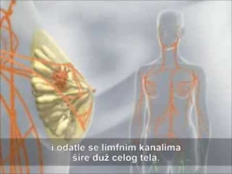 Video: Oralni Karcinom: Faktori Rizika, Dijagnoza I Liječenje