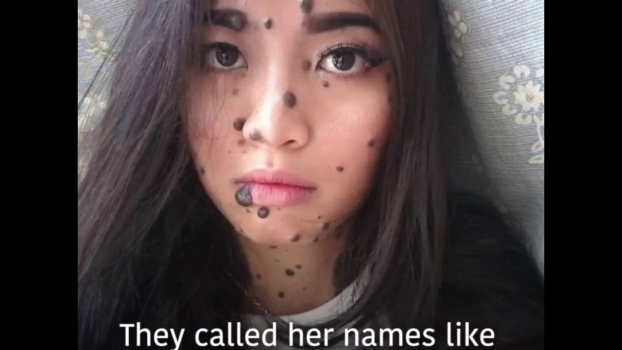 Malaysian Girl Born With Moles Covering Her Body -1370