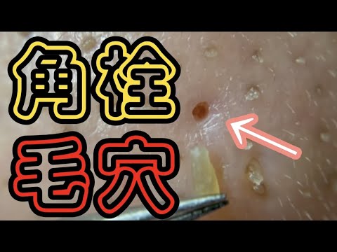 【スッキリ】久しぶりの角栓収穫！part9 Blackheads