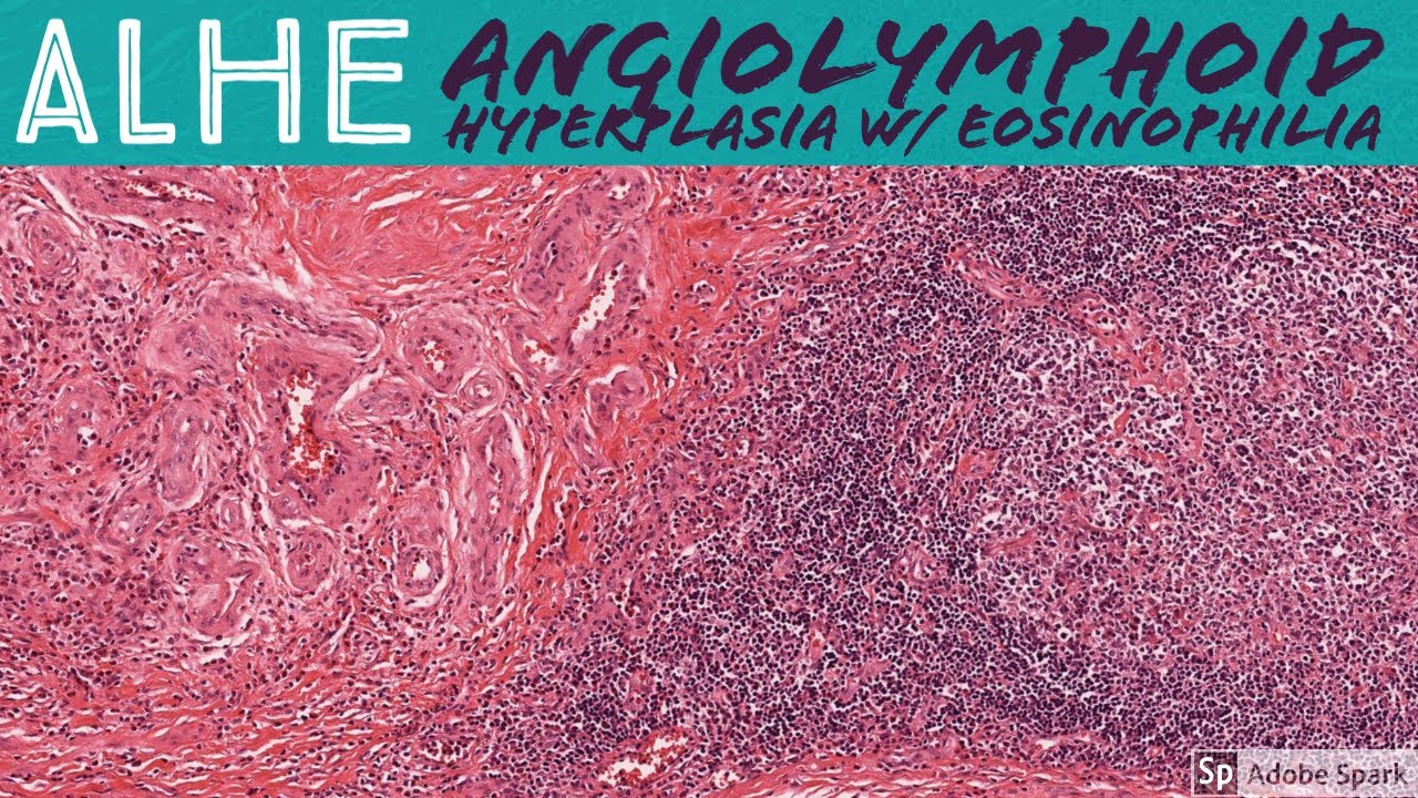 ALHE (Angiolymphoid Hyperplasia with Eosinophilia): 5-Minute Pathology ...