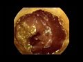 Pill Camera Swallowed | Follow Through Gut | Guts | Earth Science