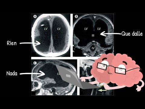 Vidéo: Quelle était la taille du cerveau de l'homme d'Heidelberg ?