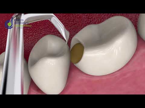 Video: Effetto Rimineralizzante Del Vetro Bioattivo 45S5 Sulla Carie Artificiale Nella Dentina