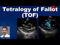 Tetralogy of Fallot TOF