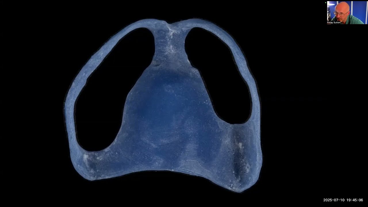 Д-р Финли Саттон – Немедленный полный верхний съемный протез: от удаления до окончательной подгон...