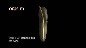 Cold Hydraulic Obturation Technique
