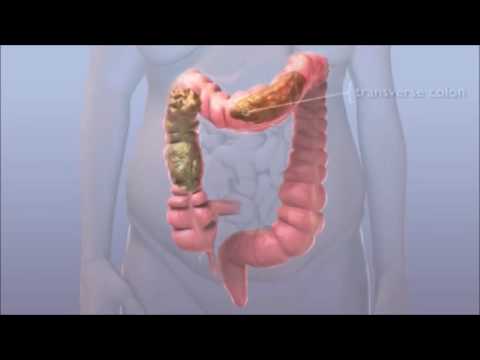 Video: Come prevenire l'ostruzione dell'intestino tenue: 12 passaggi (con immagini)