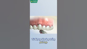 Trồng Răng Implant Có Niềng Răng Được Không?  #niengrang #xuhuong #dentist #nhakhoadrhangnam