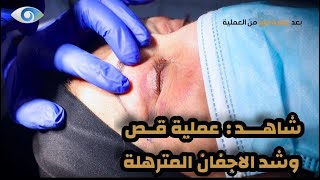 شاهد رأي المريضة بالنتيجة الرائعة لـ عملية تجميل الاجفان - حصريا من صالة العمليات