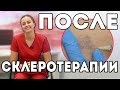 Период восстановления после склеротерапии