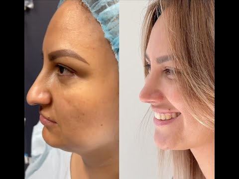 Video thumbnail: 4D Nose Approach - 1 Year Results - Testimonial | As Seen On Instagram & TikTok · Dr. Anil Shah