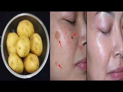 Vidéo: Remèdes à La Maison Pour La Pigmentation: Comment éliminer Les Taches Sombres