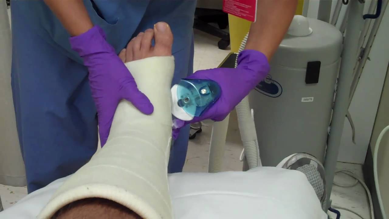 How To Take Off A Fiberglass Leg Cast Youtube