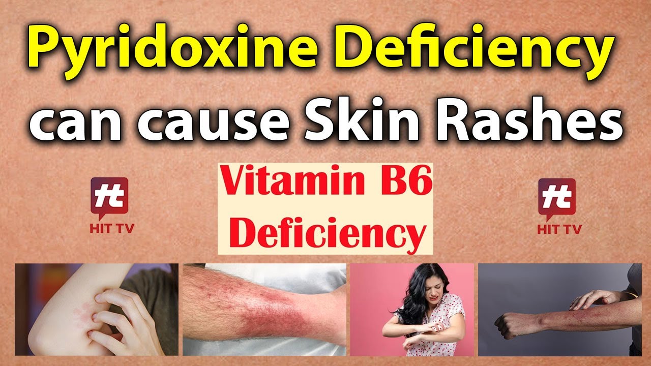Pyridoxine Deficiency causes Skin Rashes Hit TV Indian Health health healthtips healthy