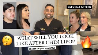How You'll Look After Chin Lipo: Before and After