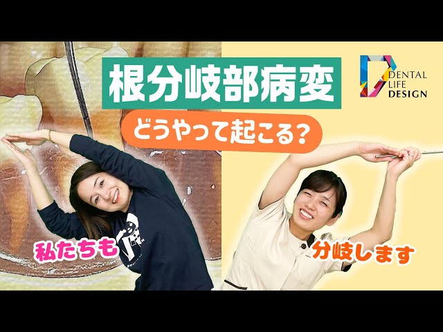【裁断済み】長期経過症例から紐解く根尖病変と骨縁下欠損 裁断済み】長期経過症例から紐解く根尖病変と骨縁下欠損
