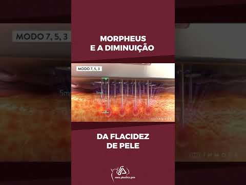 Morpheus - tecnologia para diminuir a flacidez de pele