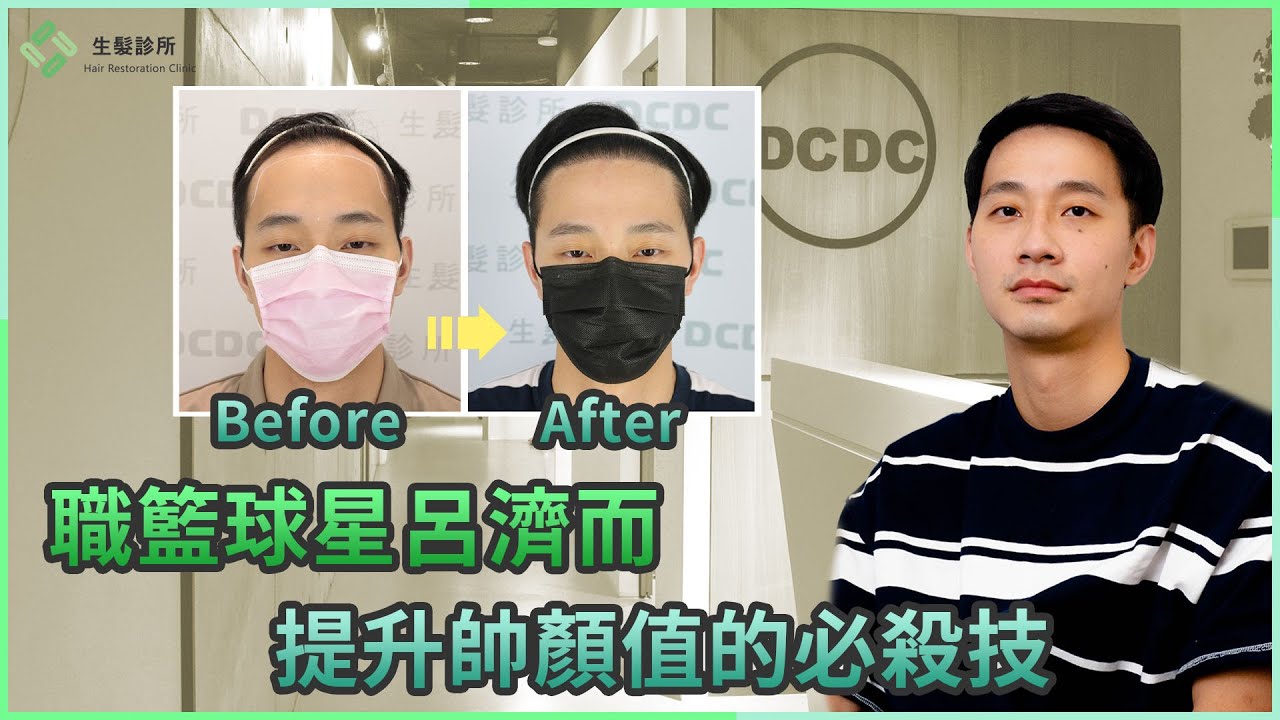 職籃球星呂濟而 提升帥顏值的必殺技｜植髮案例分享｜DCDC精準植髮