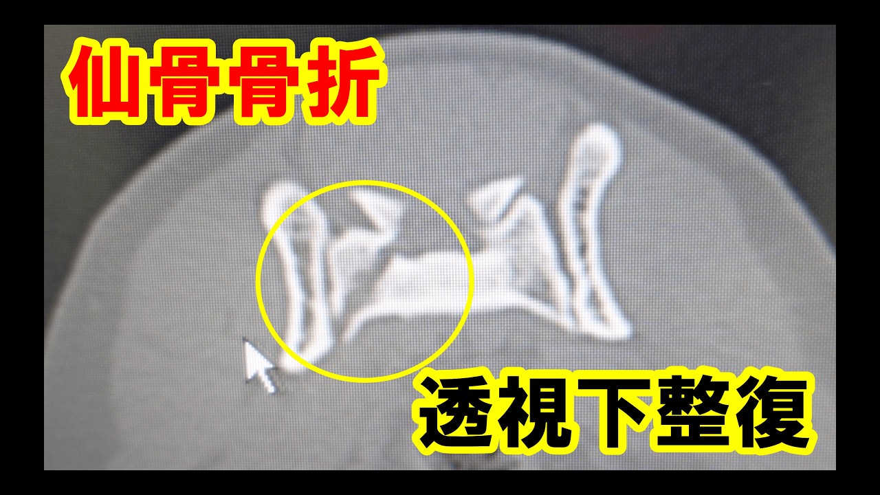 透視下での仙骨骨折整復術