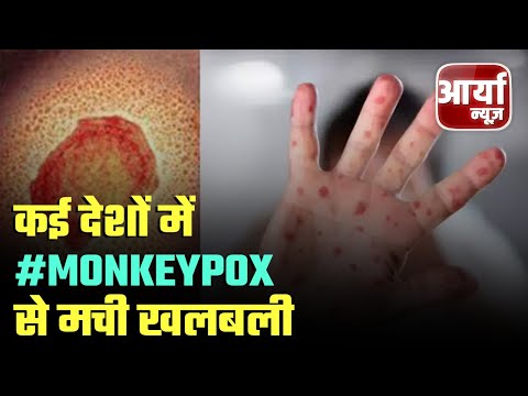 Monkeypox Virus: कई देशों में #Monkeypox से मची खलबली | अमेरिका में ९ मामलों की पुष्टि | AaryaaNews