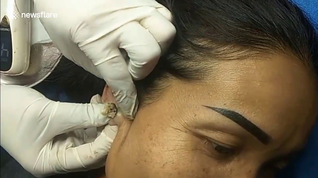 Dermatologist extracts massive 15 year old blackhead from woman's ear