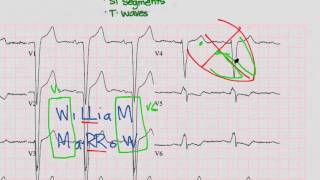 Practice EKG 11