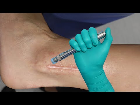 Keloidni ožiljak i liječenje DermoJet injektorom / Keloid scars and DermoJet Injector treatment