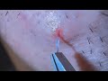 Plucking facial hair & ingrown hair 1345 頬髭抜き(埋没毛あり)