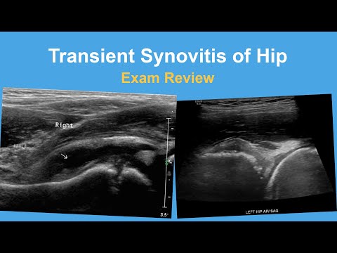 Transient Synovitis of Hip Exam Review - Michael Glotzbecker, MD