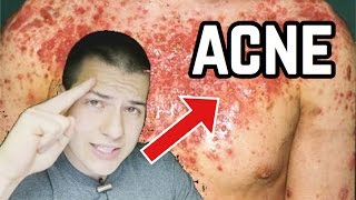 De como parar a esteróides acne