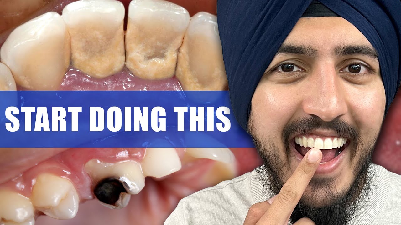 The 1 Top Remedy for Dental Plaque, Tartar, and Cavities YouTube