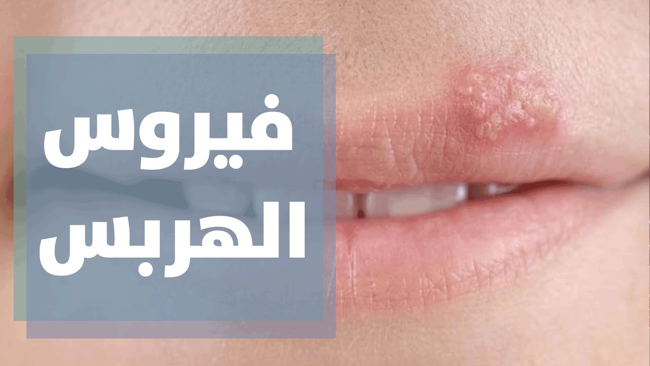 ما هو فيروس الهربس؟