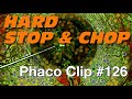 Phaco clip 126  hard stop  chop
